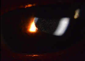 Kanghua digital slit lamp illustration: aqueous humor