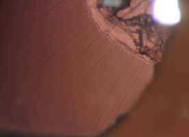 suspensory ligament, lens dysplasia, capsule organization pulling to the temporal side, nasal suspensory ligament can be seen.